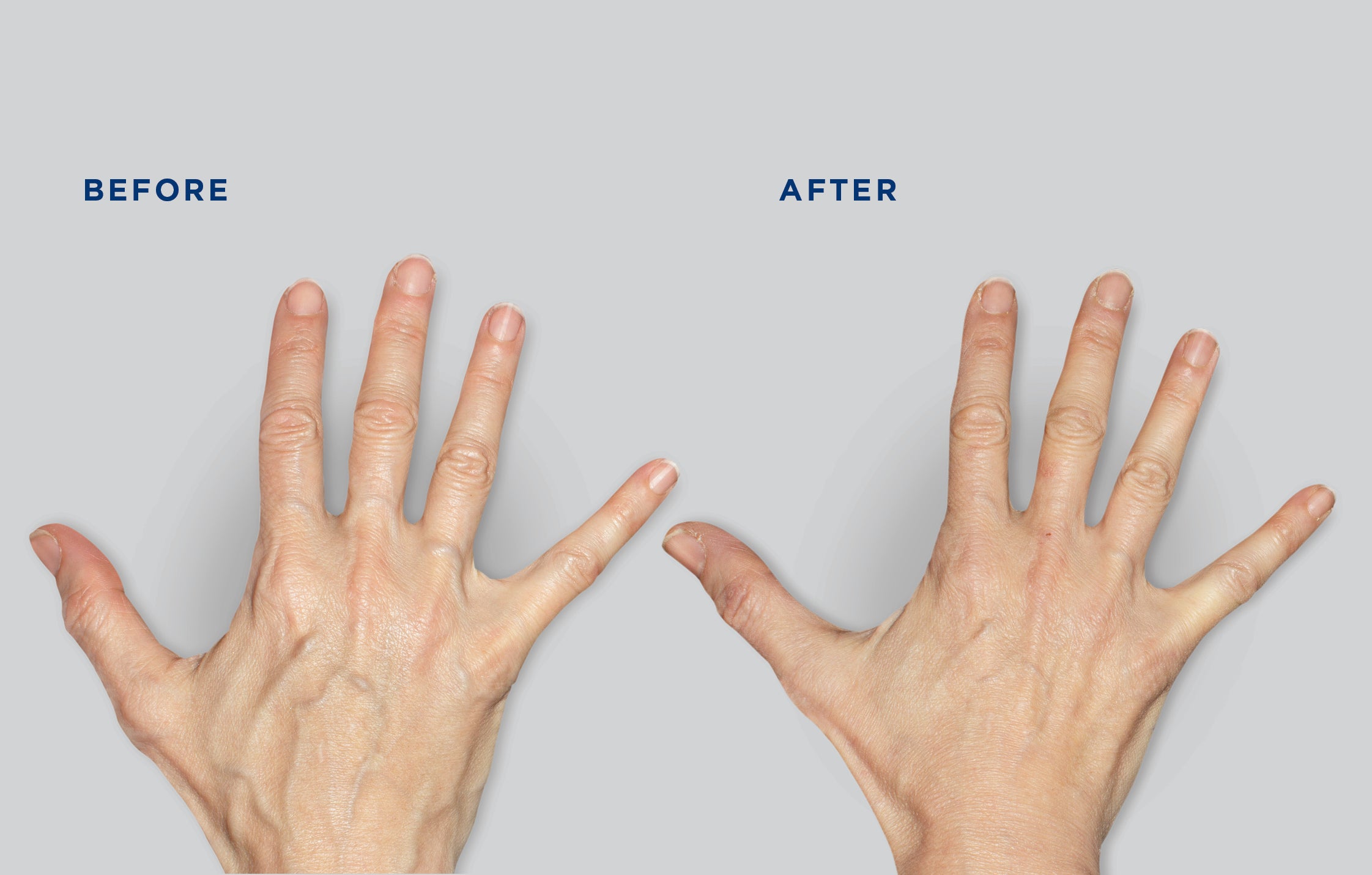 dehydrated-hands-try-the-hand-treatment-for-younger-looking-hands-that